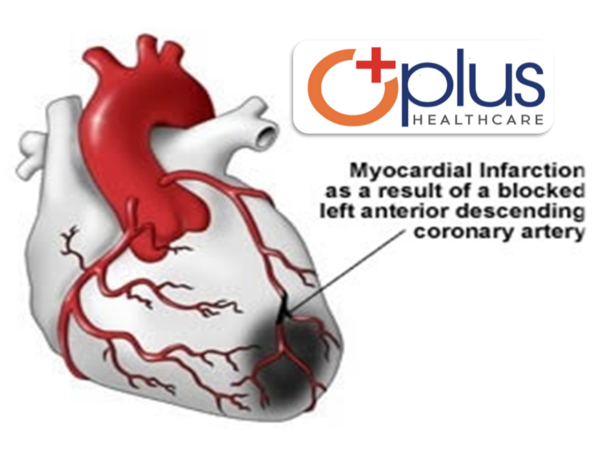 Coronary Artery Blockage Cure For Details Call Oplus Team For Free Consultation Prevention Of Myocardial Infarction Or Heart Attack Myocardial Infarction Or Heart Attack Is A Type Of Acute Coronary