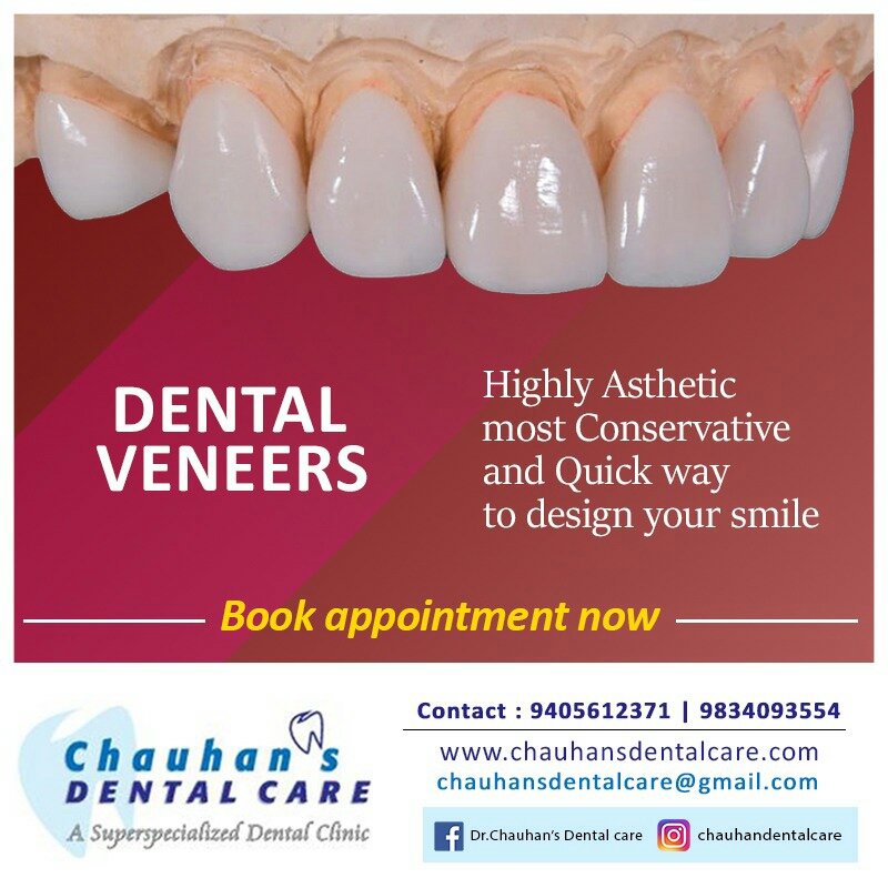 Dental Veneers-best dental clinic In Balewadi main image