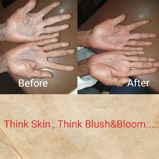 Eczema is curable.....
Think_Skin_Think_Blush_& _B... main image