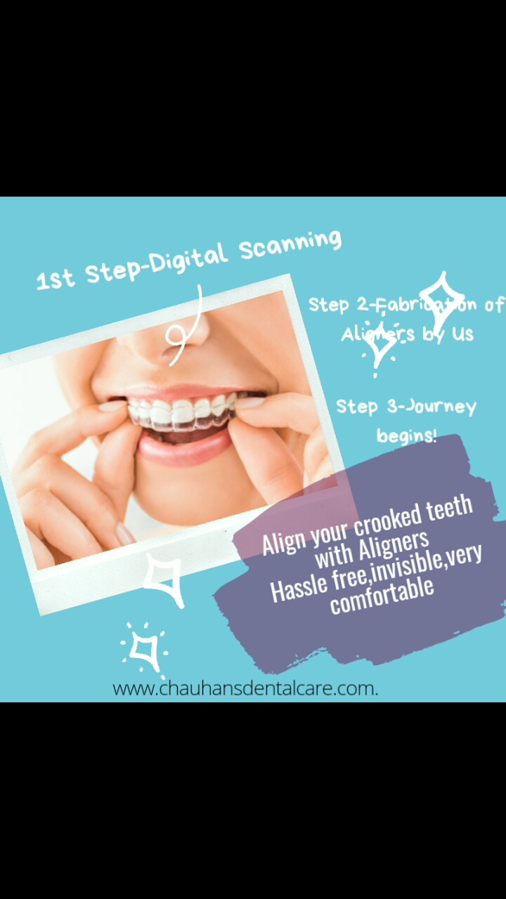Aligners treatment in Balewadi main image