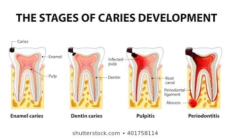 What Is a Dental Cavity?

A cavity or hole in t... main image