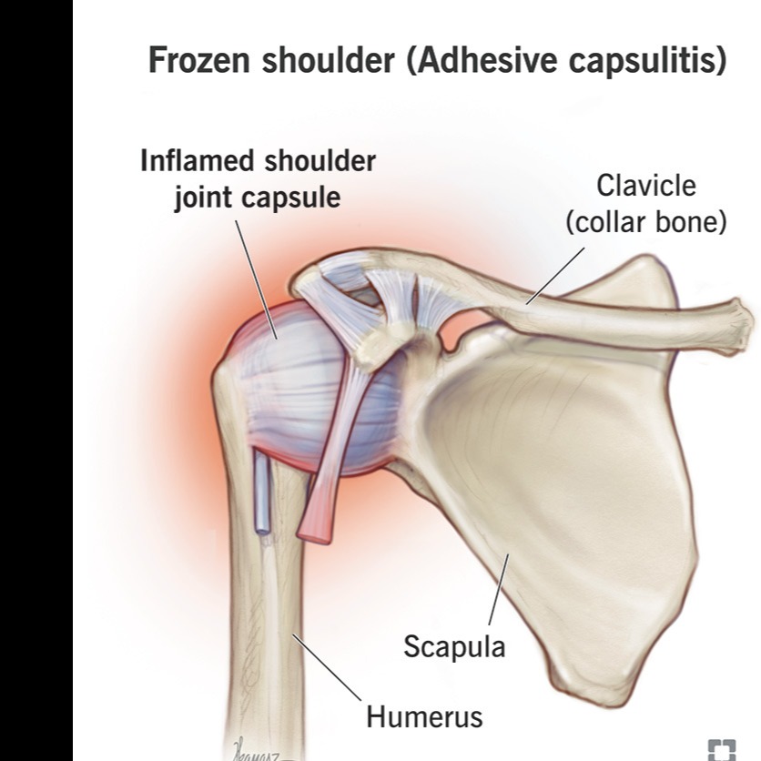 pain stiffness