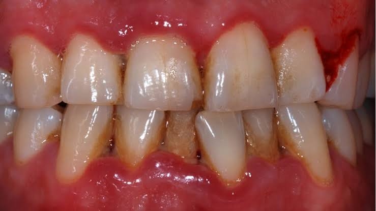 Pyorrhoea
An infection that damages gums and ca... main image