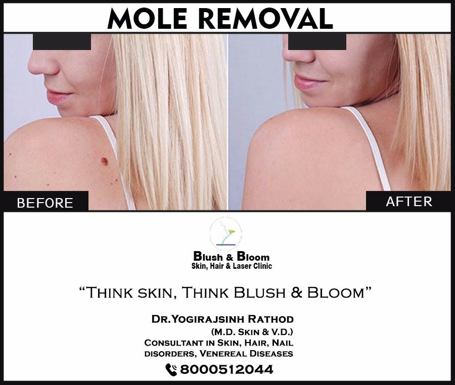 Mole removal is painless, permanent, stitchless... main image