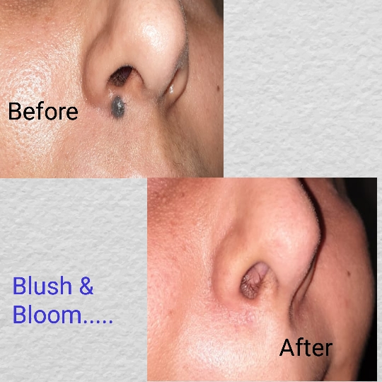 Mole removal is painless, permanent, stitchless... main image