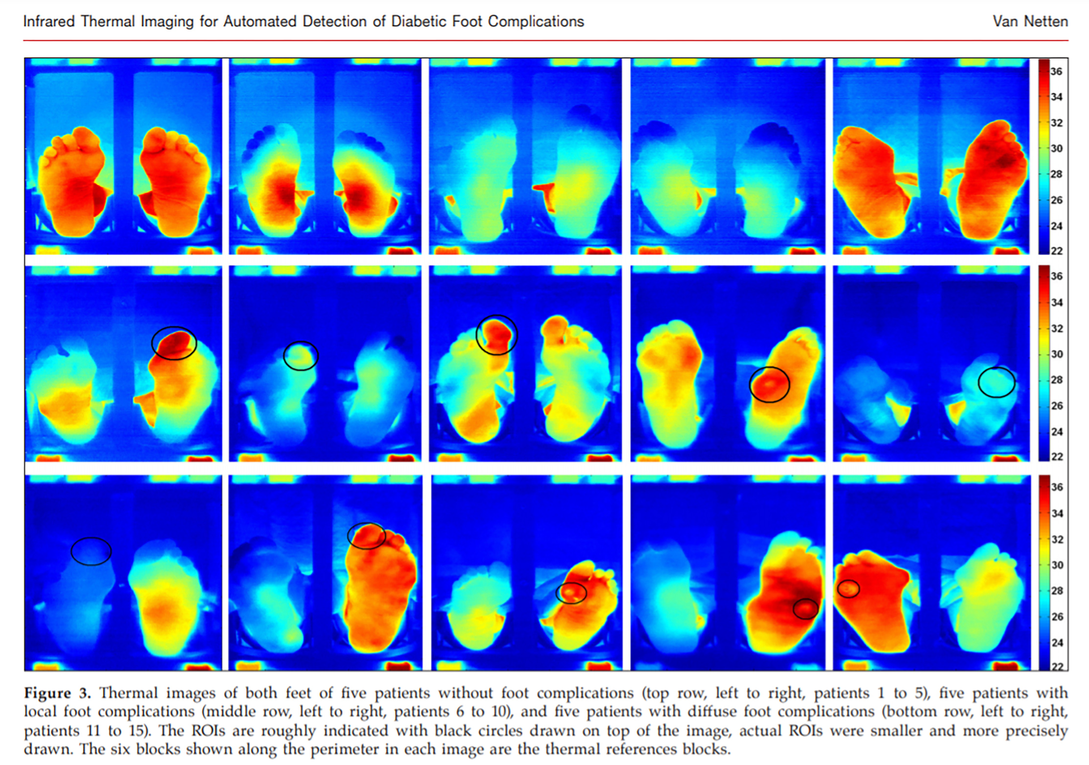 Medical infrared thermography FLIR C5 Diab Diabetik Foot Care India