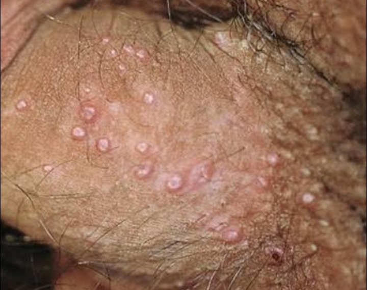 hpv wart itchy hpv vescica sintomi