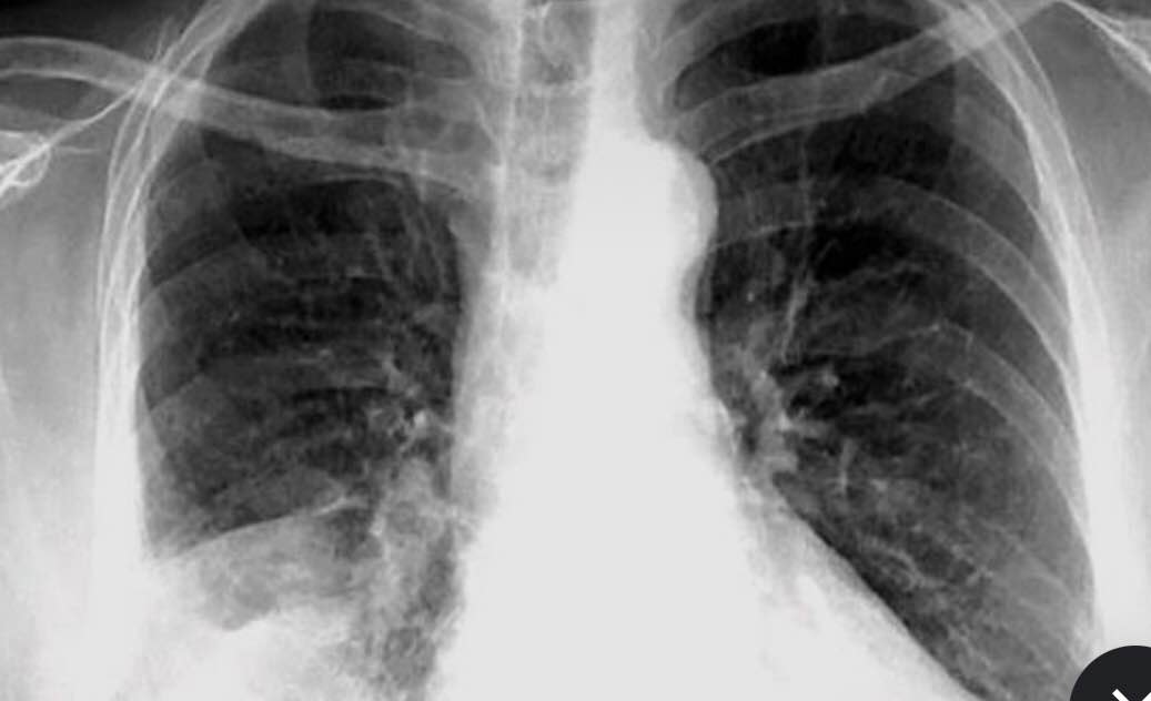 PNEUMONIA??? At Pneumonia and your lungs Open popup dialog box Pneumonia