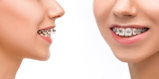 If you have crooked teeth or a misaligned bite, re... main image