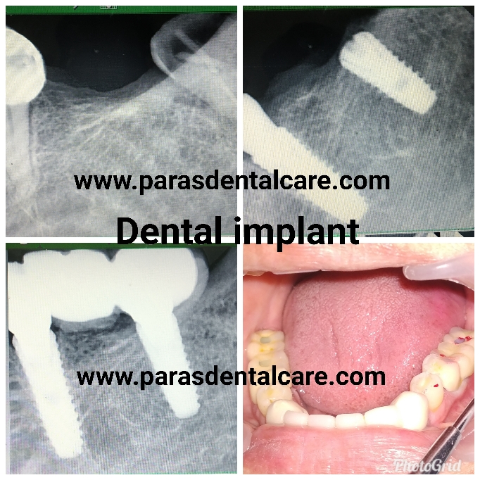 
What should you choose - bridge or Implant?
On... main image