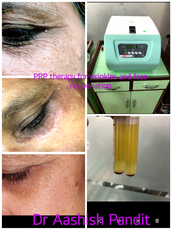 PRP (platelet rich plasma) is a effective and safe... main image