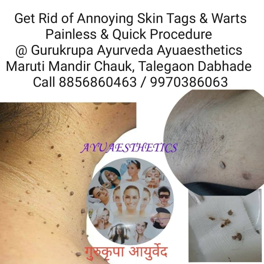 Get Rid of Unwanted Skin Tags, Warts, Keloids or Growths with Pain less