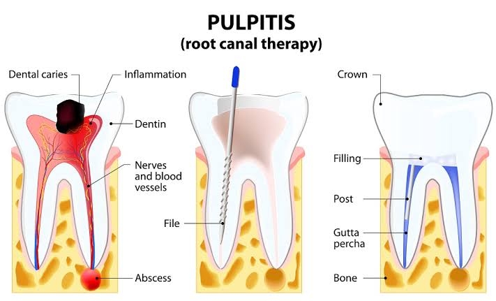If there is a deep cavity, a cracked tooth, or ... main image