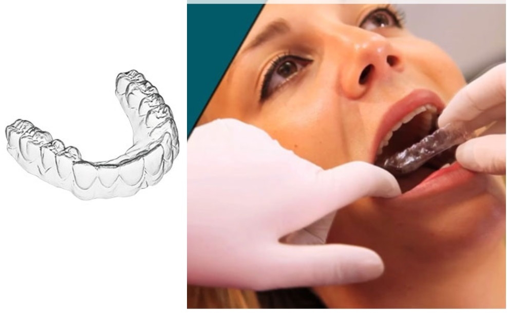 Aligners are the esthetic, durable and the late... main image