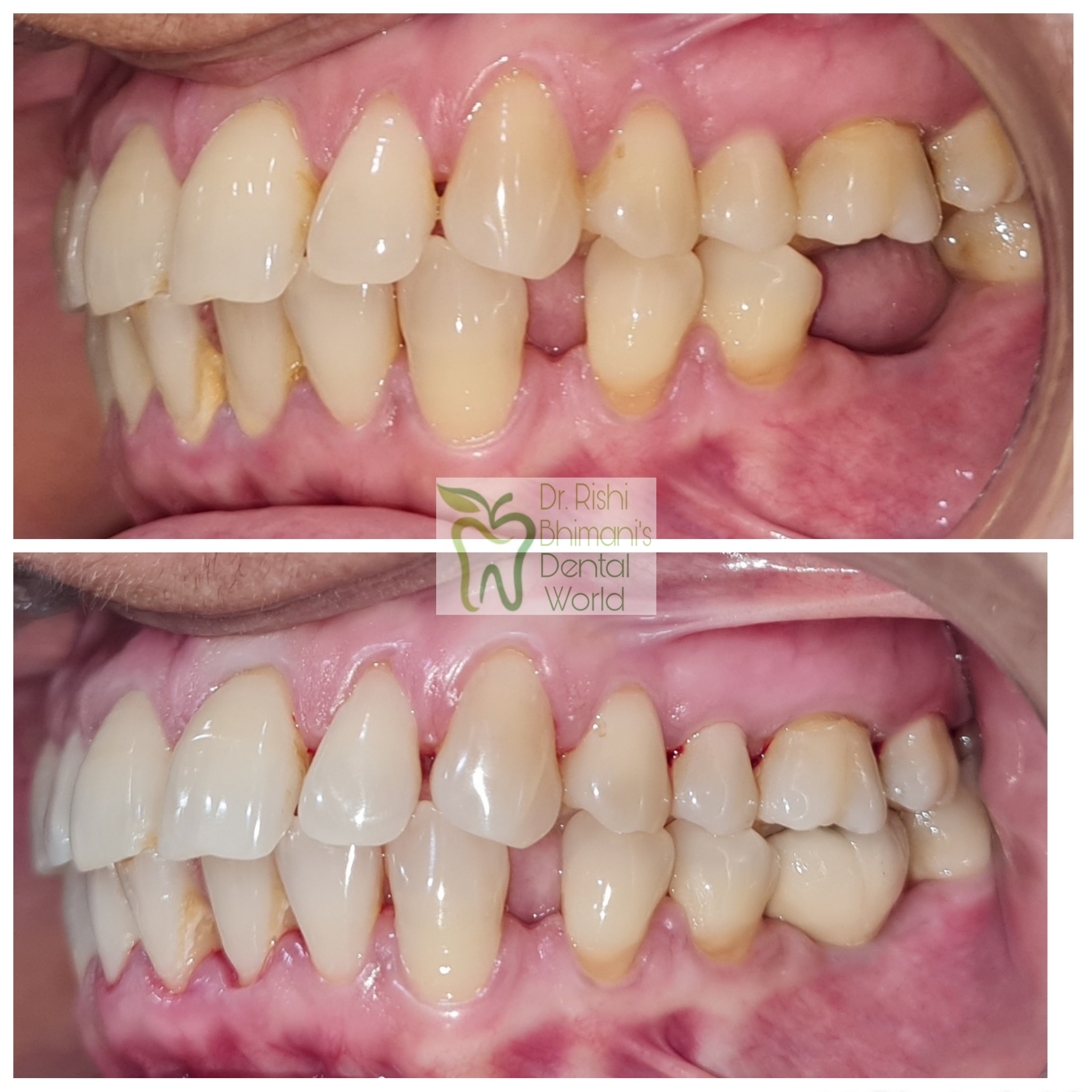 A MISSING MOLAR TOOTH can severely affect the c... main image
