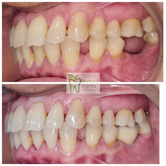 A MISSING MOLAR TOOTH can severely affect the c... main image