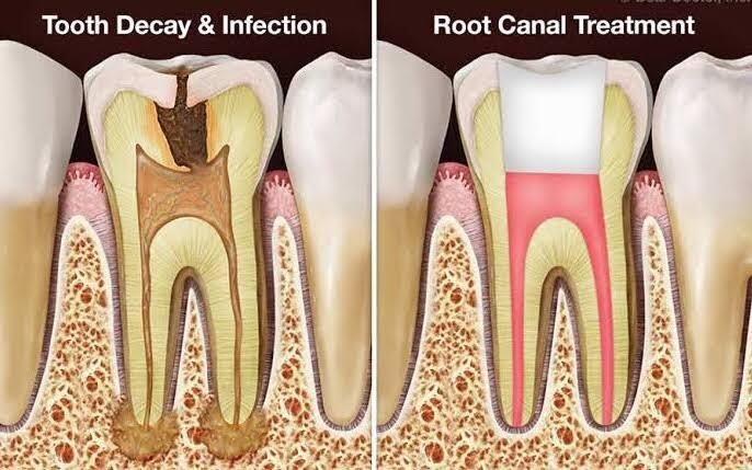 Many people worry that a root canal treatment will... main image