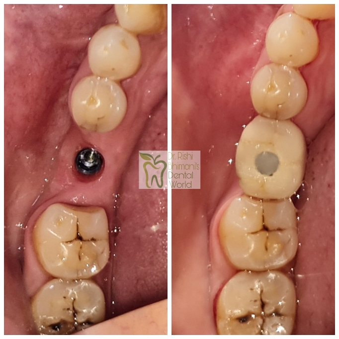 A MISSING MOLAR TOOTH can severely affect the c... main image