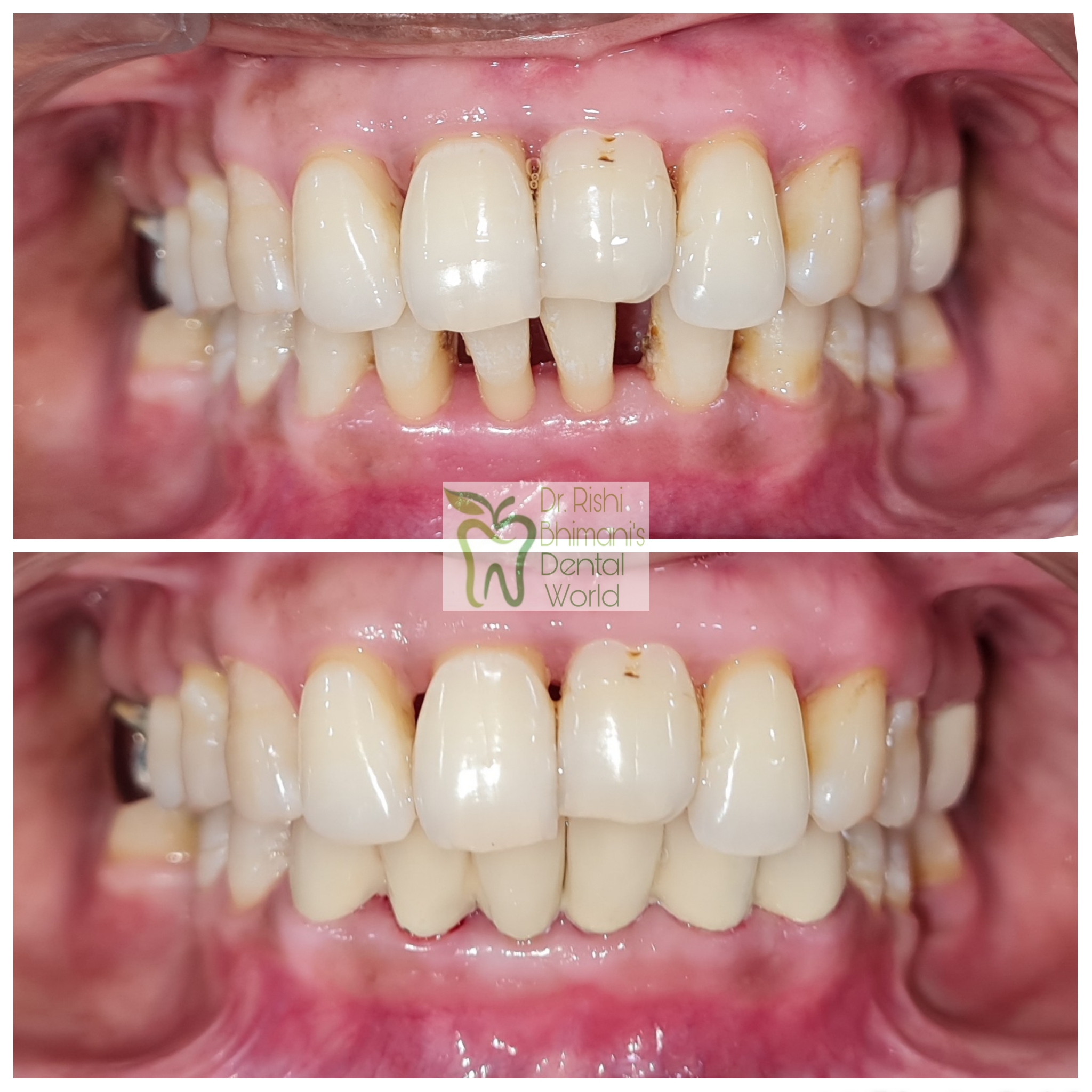 Gaps between front teeth can be fixed by SMILE ... main image