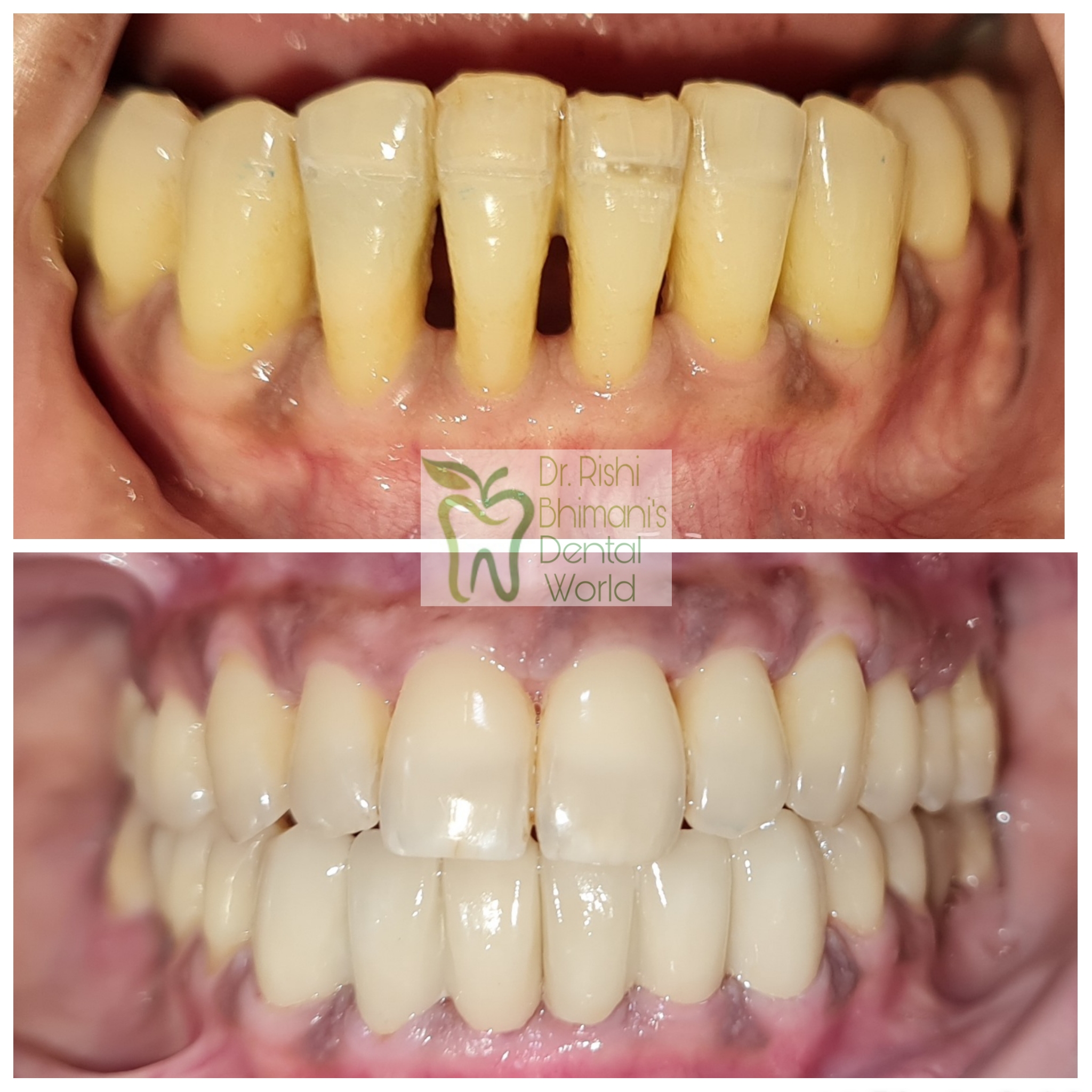 Gaps between front teeth can be fixed by SMILE ... main image