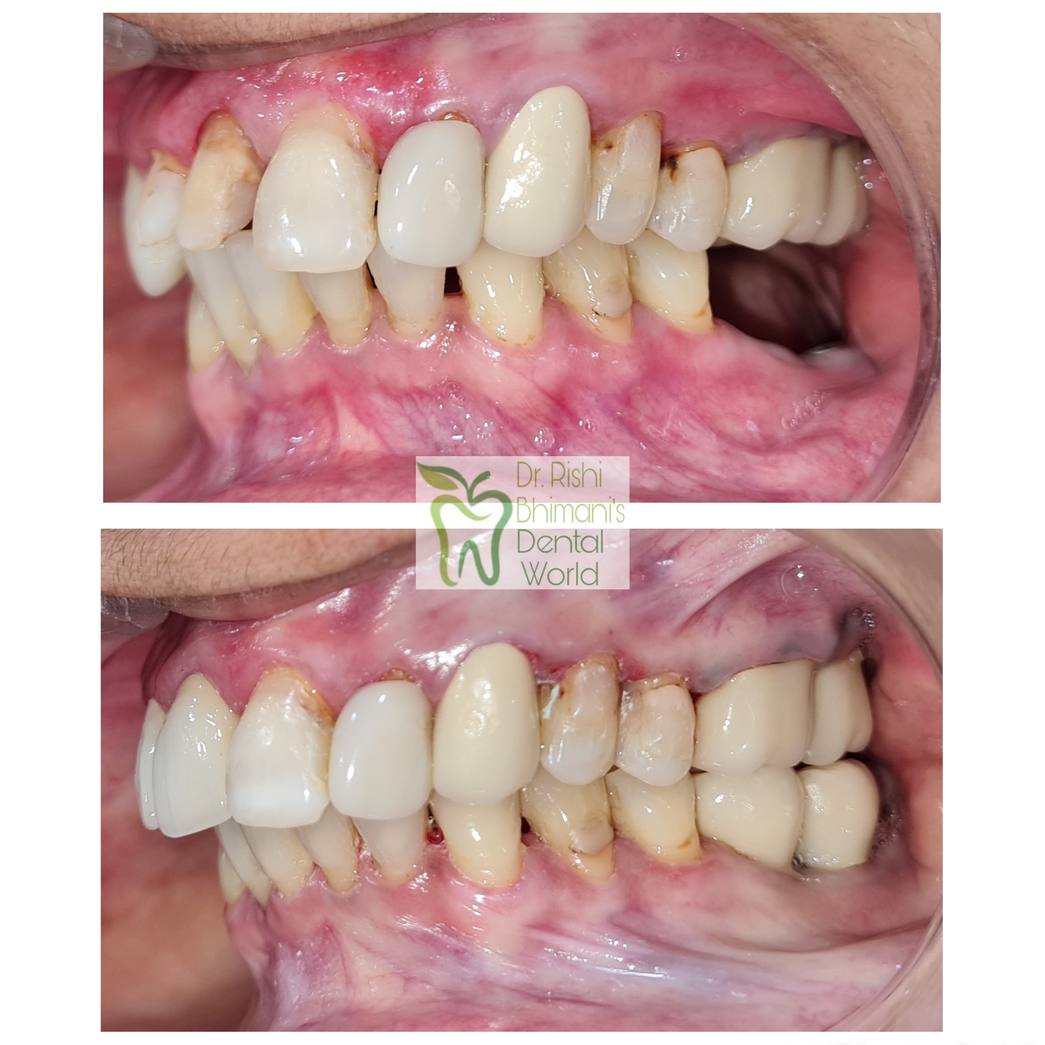 MISSING TEETH can severely affect the chewing a... main image