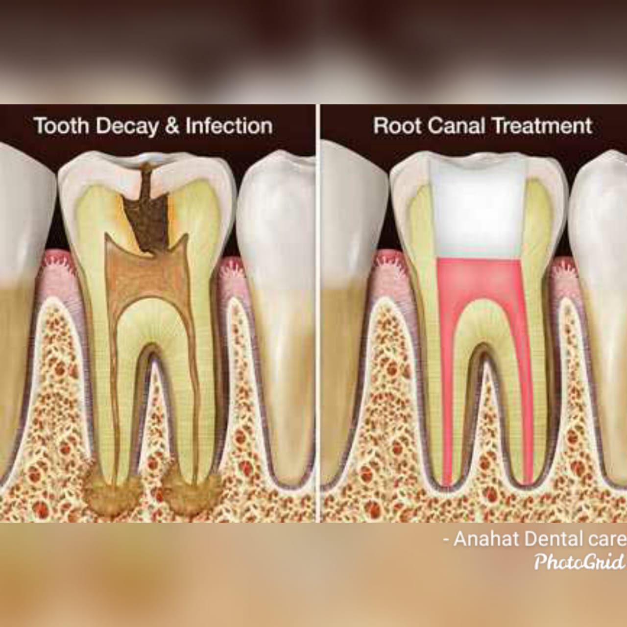 What is tooth decay and infection ? Bacteria can enter the innermost