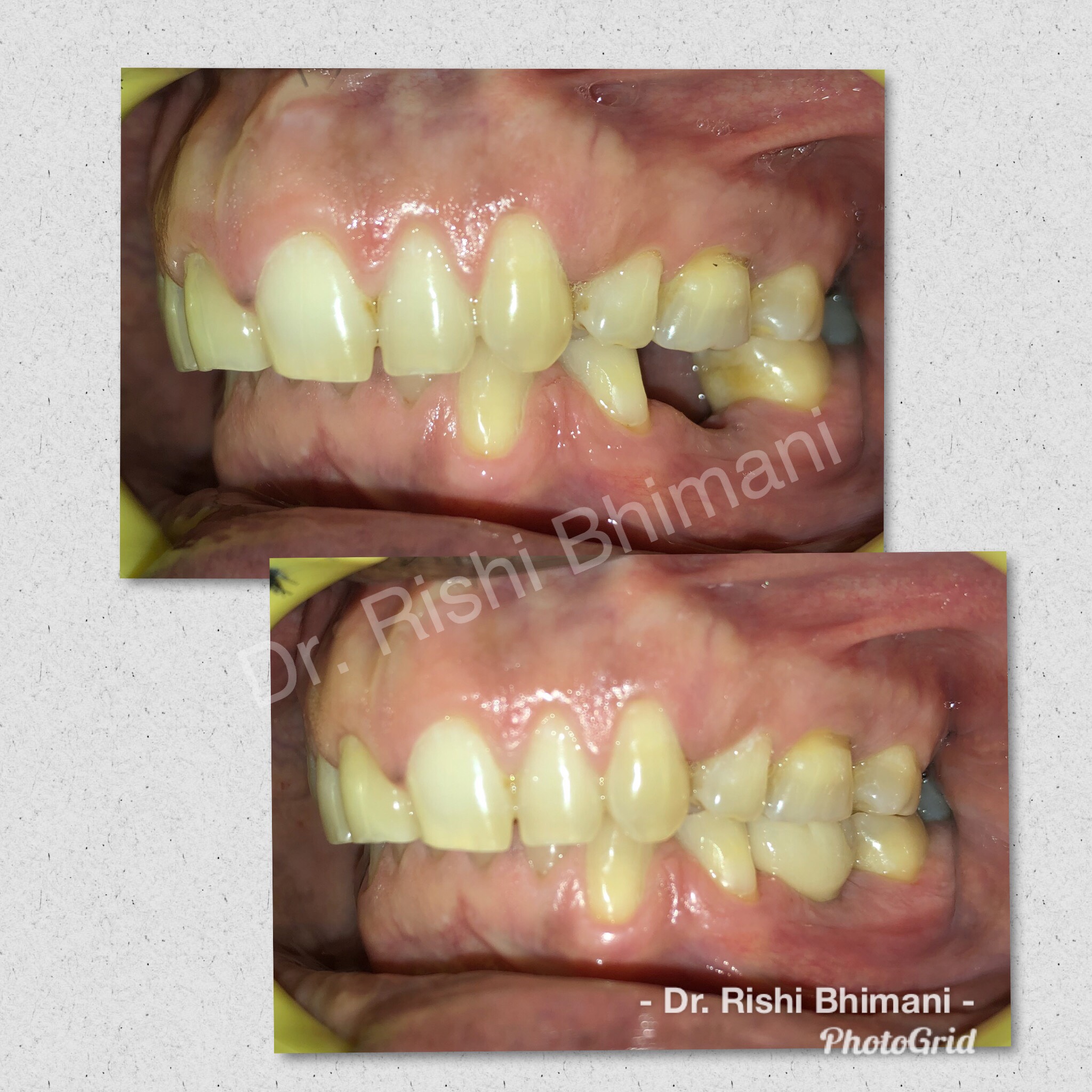A MISSING MOLAR TOOTH can severely affect the c... main image