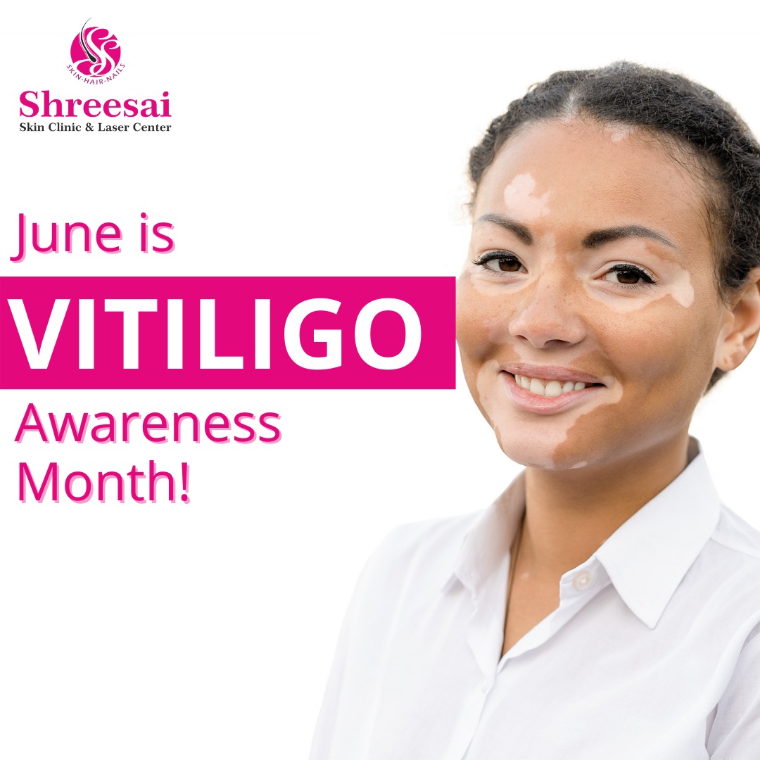 June has become known as Vitiligo Awareness Mon... main image