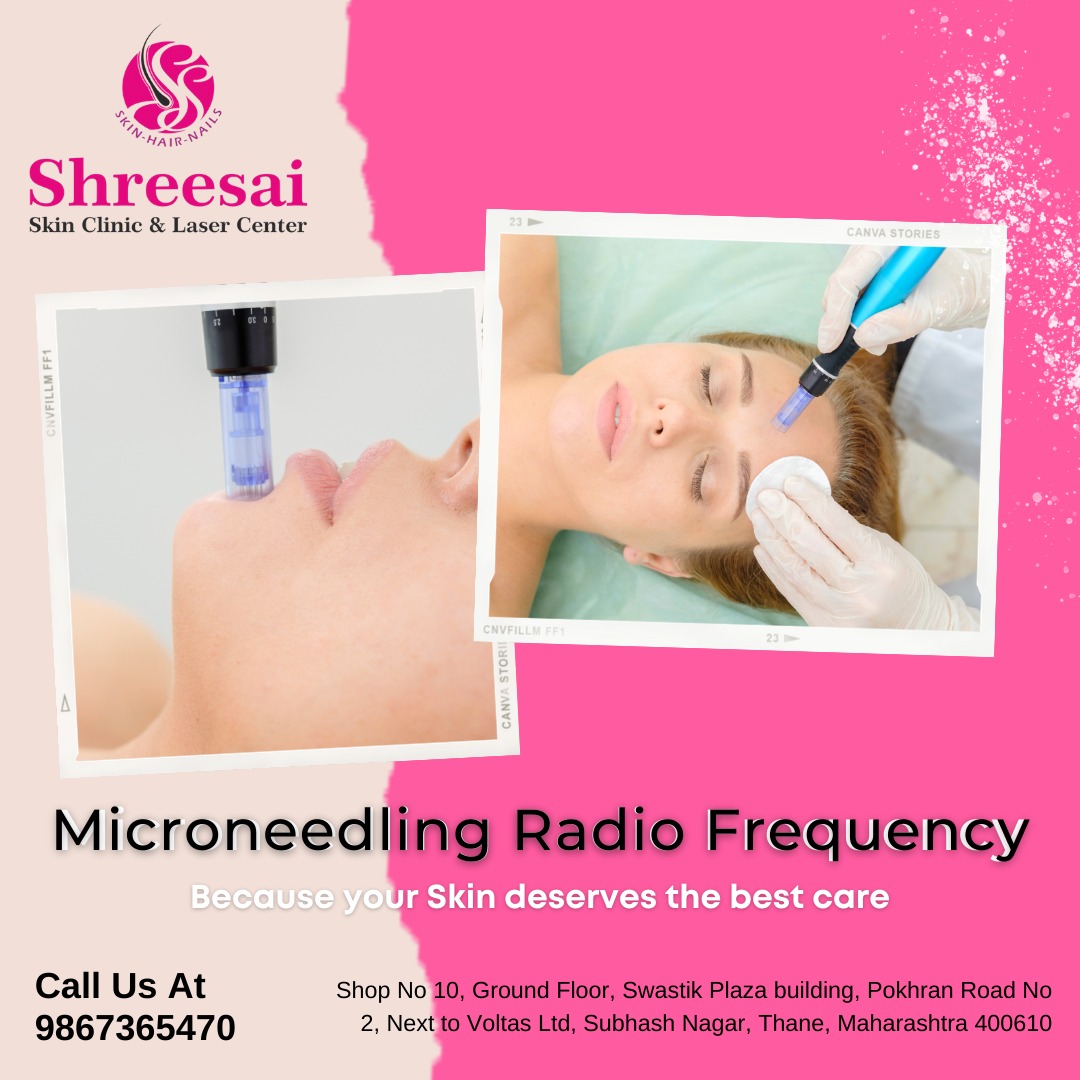 Radiofrequency micro needling is used to rejuve... main image