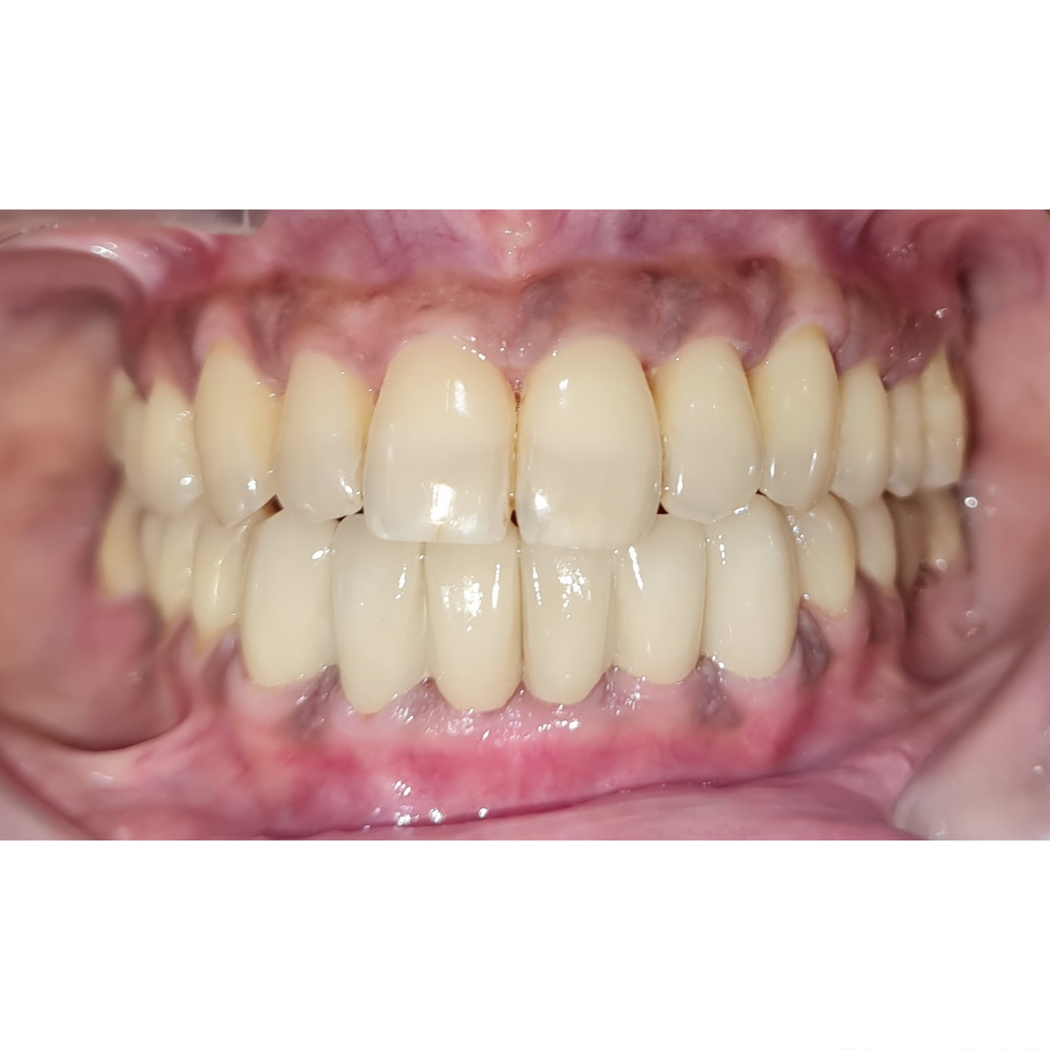 Gaps between front teeth can be fixed by SMILE ... main image