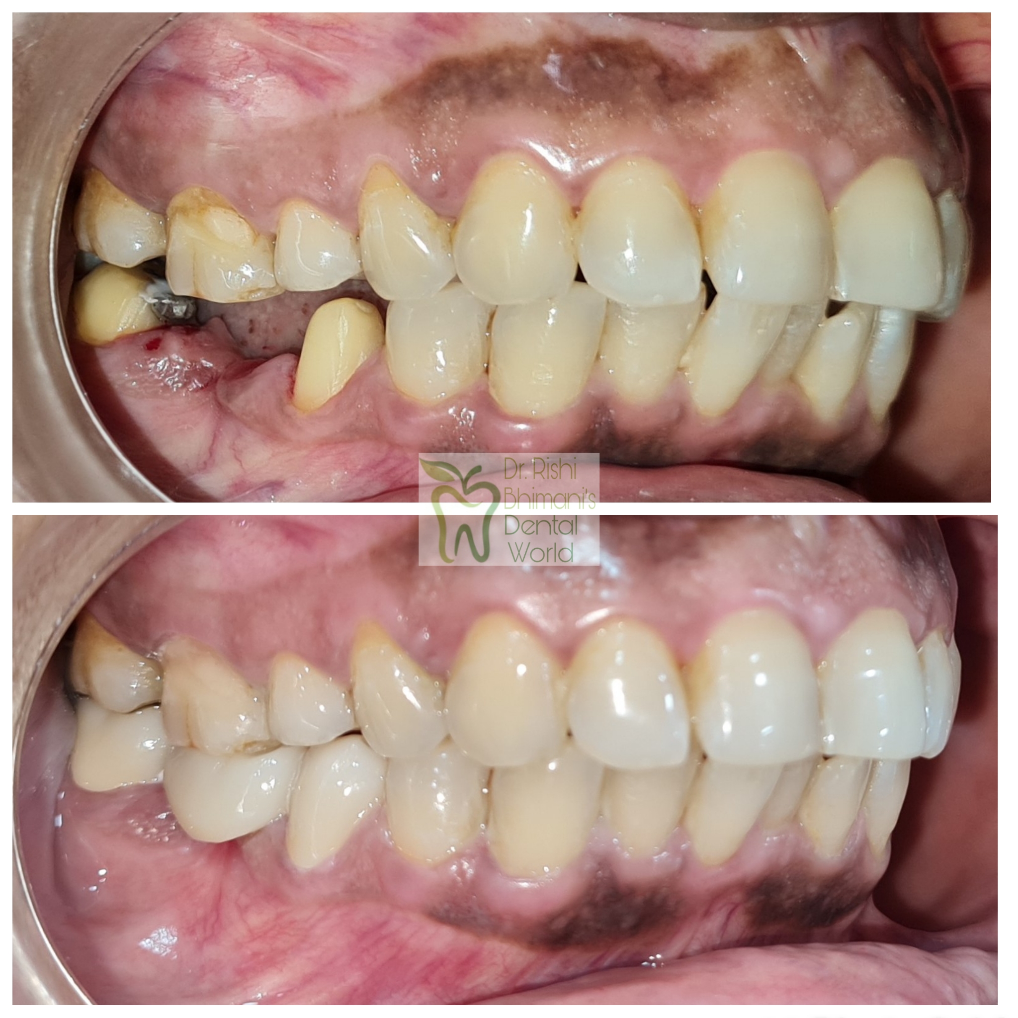 MISSING TEETH can severely affect the chewing a... main image
