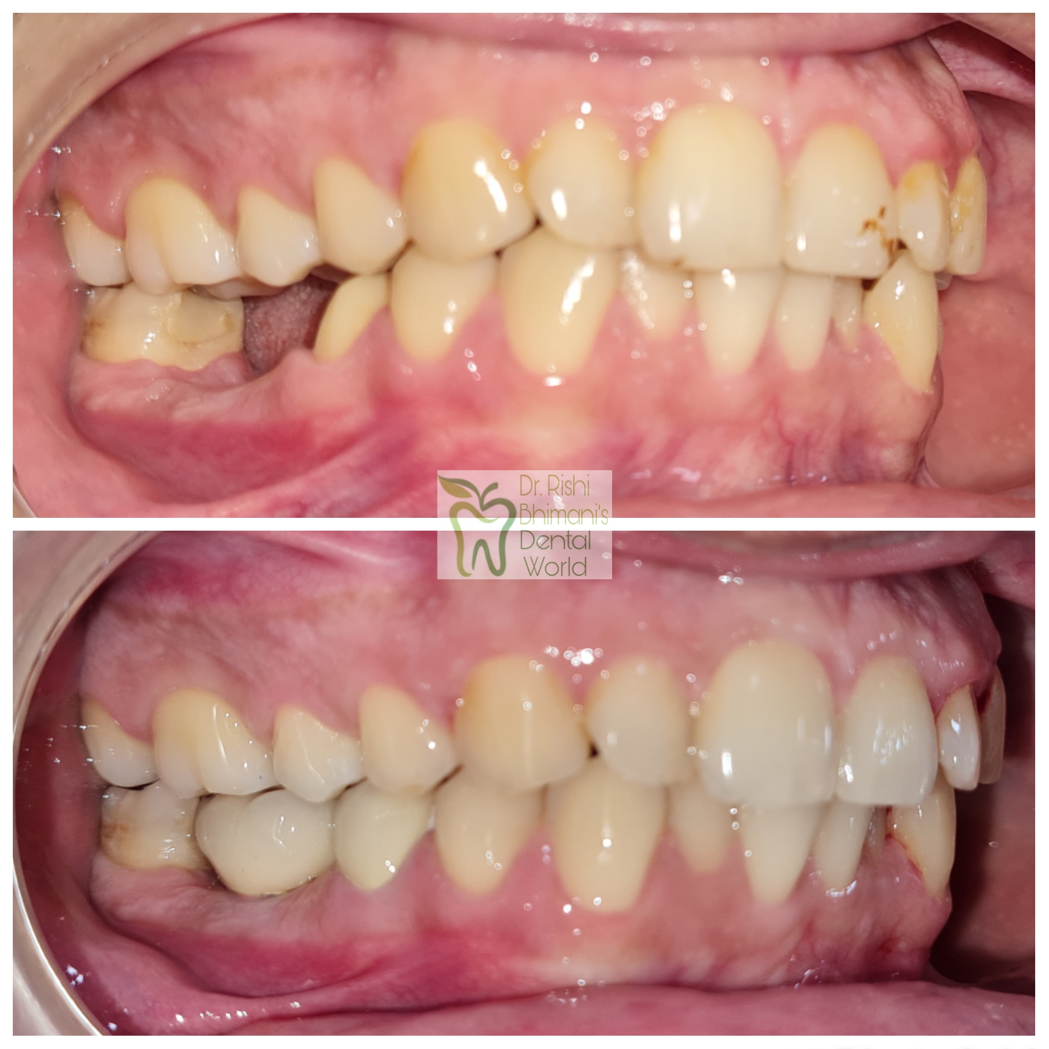 MISSING TEETH can severely affect the chewing a... main image