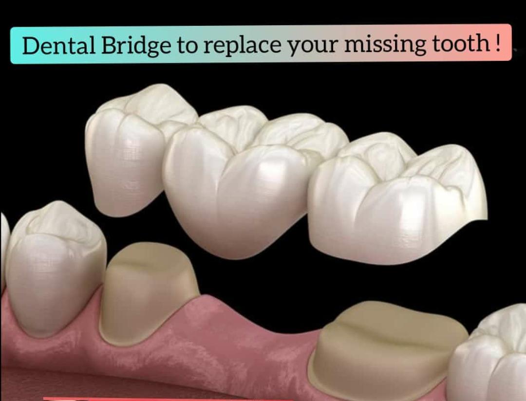Dental bridge to replace your missing teeth If you have one or more missing teeth, a dental