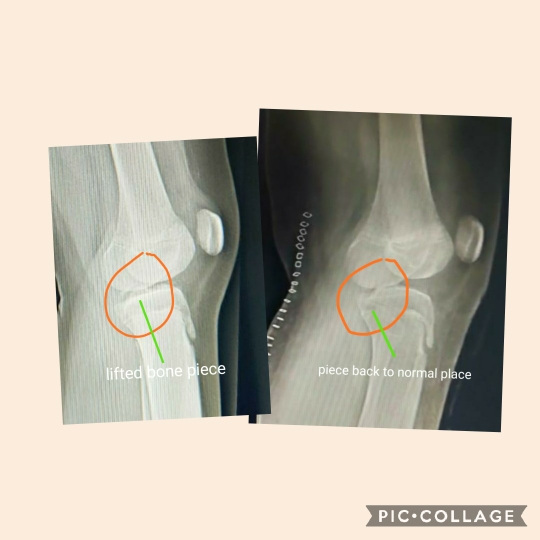 Fracture in growing age should be fixed without... main image