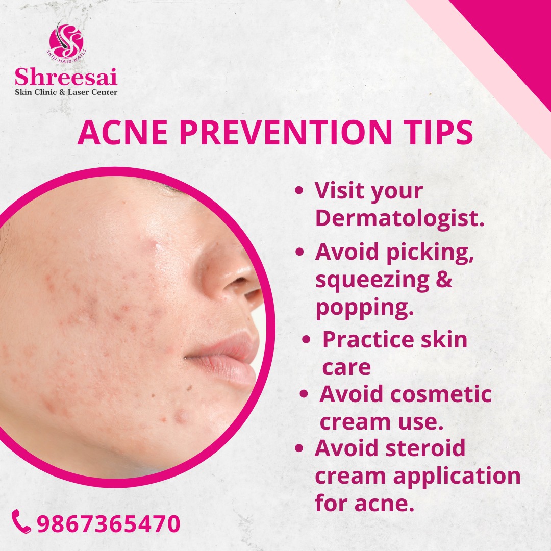 Acne is caused by various reasons such as hormo... main image