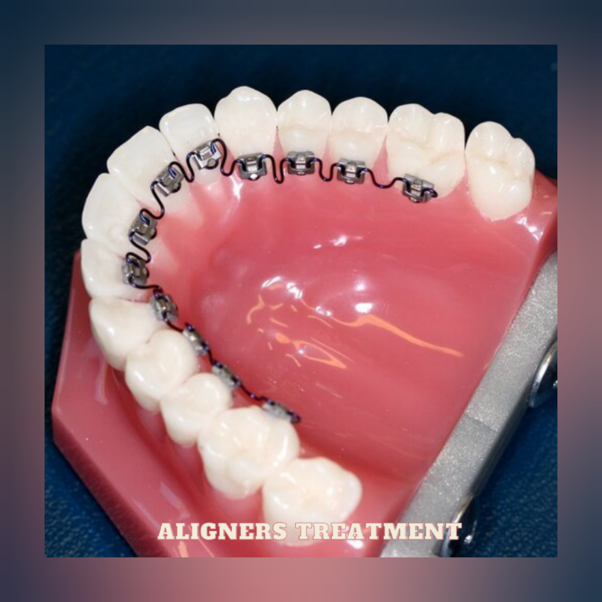 SEARCHING ALIGNERS & INVISIBLE BRACES TREATMENT... main image