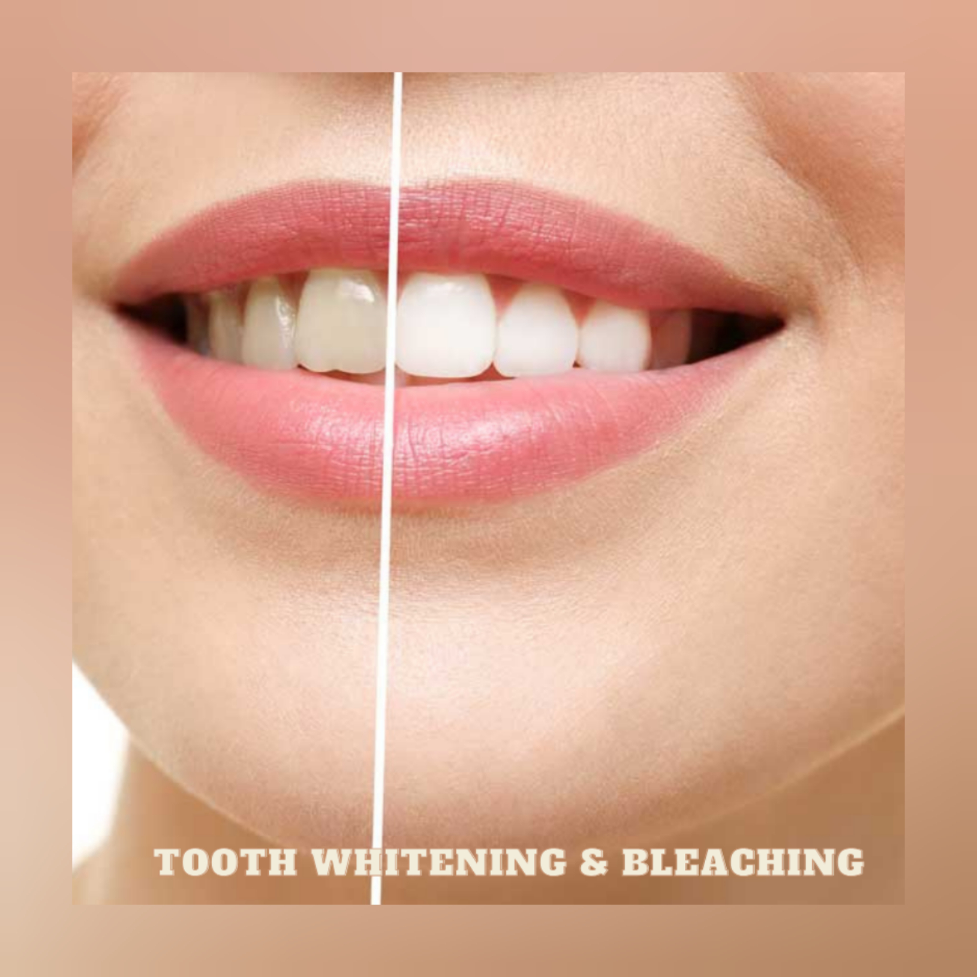 ARE YOU REQUIRED TOOTH WHITENING & BLEACHING CL... main image