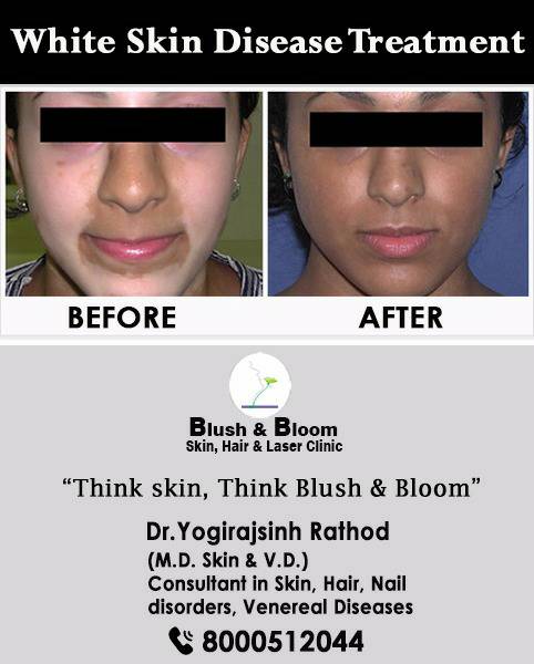 Vitiligo is curable.....

Think_Skin_Think_Blush_&... main image