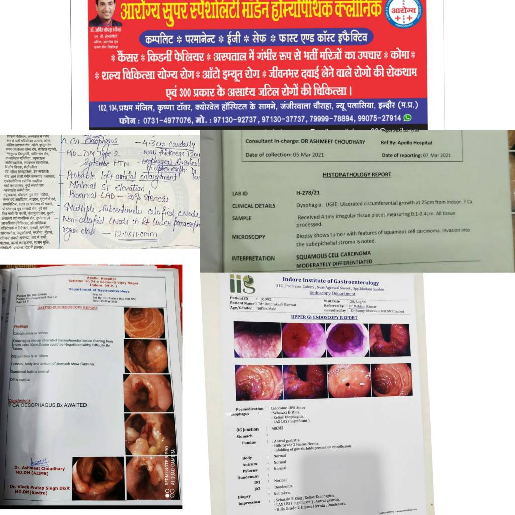 👆OESOPHAGUS CANCER CURED SUCCESSFULLY WITH RECEIVED NORMAL ENDOSCOPY