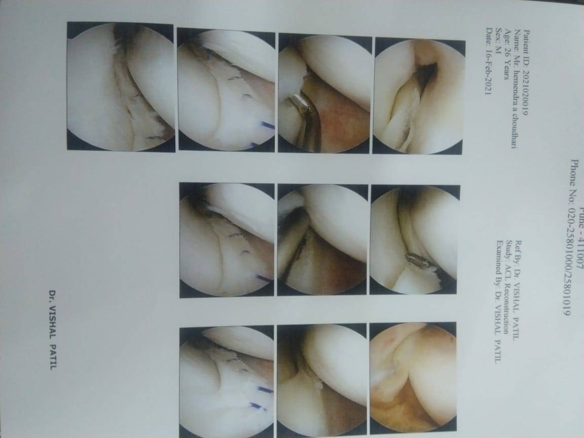Arthroscopy surgery leads to early recovery aft... main image