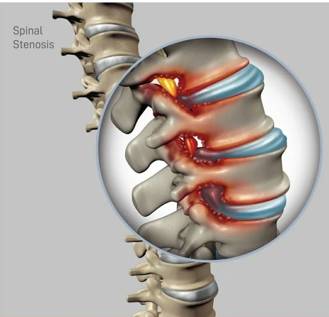 Spinal stenosis is problem of degenerative spine d... main image