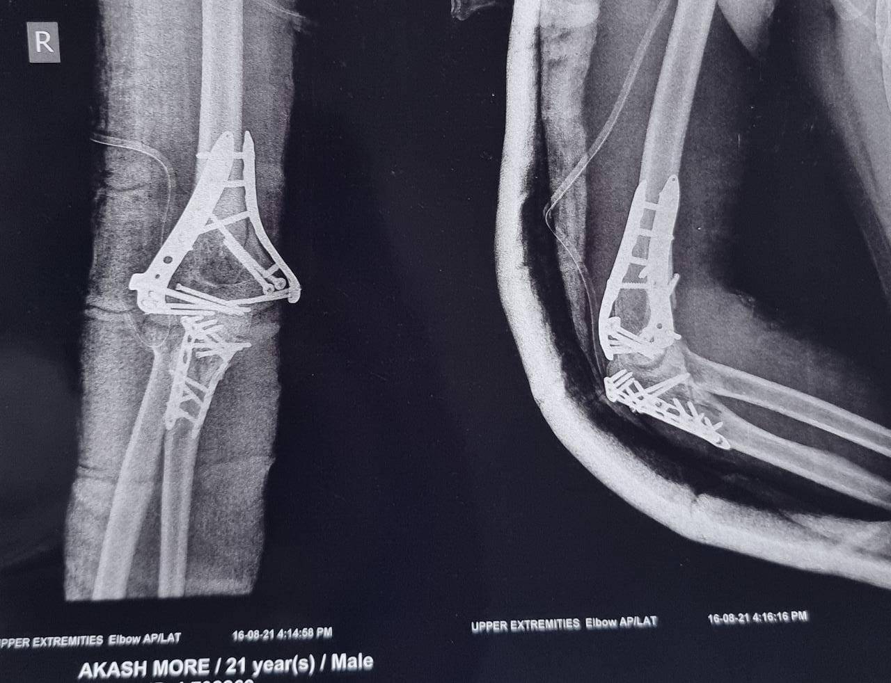 Fractures around elbow are one of the difficult... main image