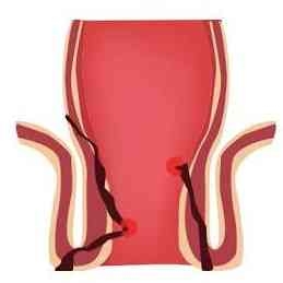 Fistula treatment
For a simple fistula that is... main image