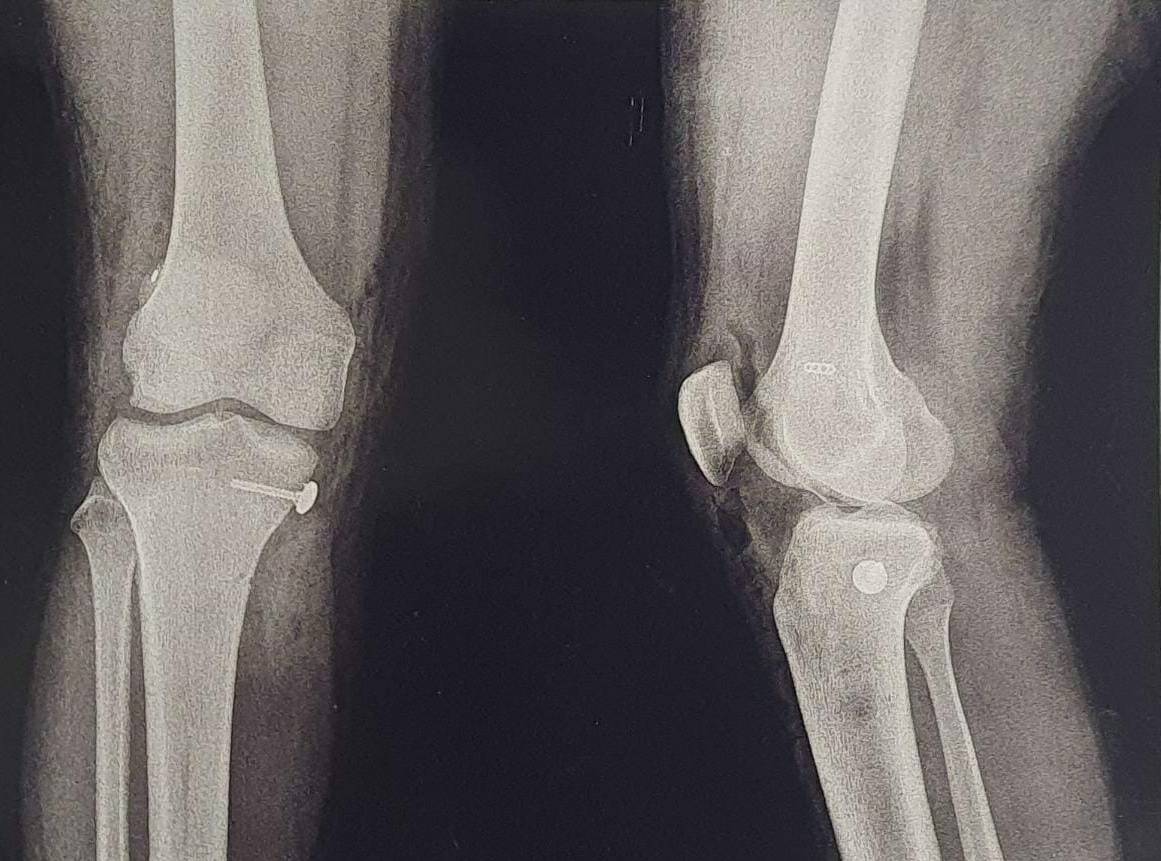 Multiligament knee injuries are difficult to treat... main image