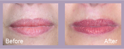 The Best laser hair reduction treatment in Chennai Tamil Nadu. Laser is