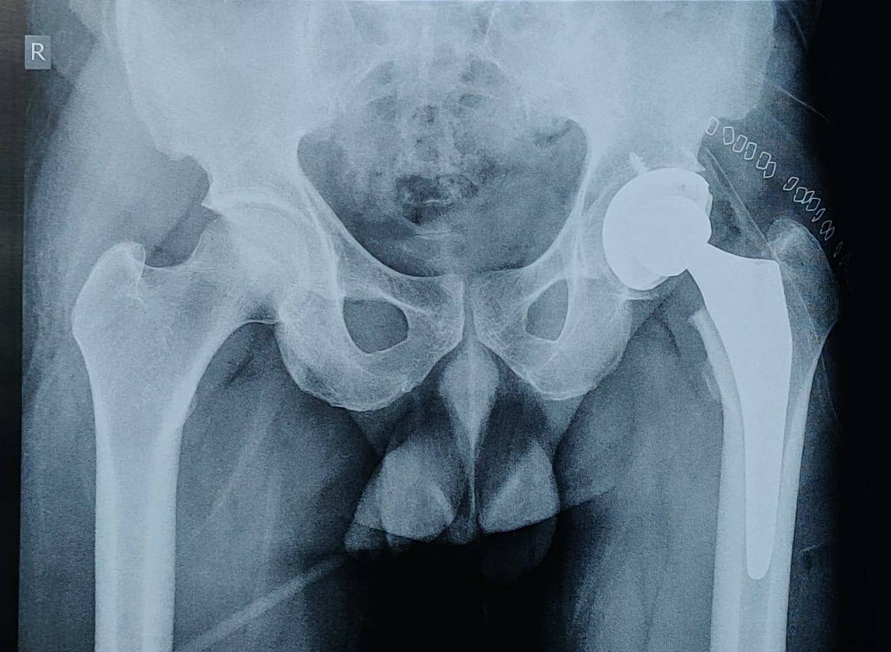 Hip arthritis is disabling condition affecting ... main image