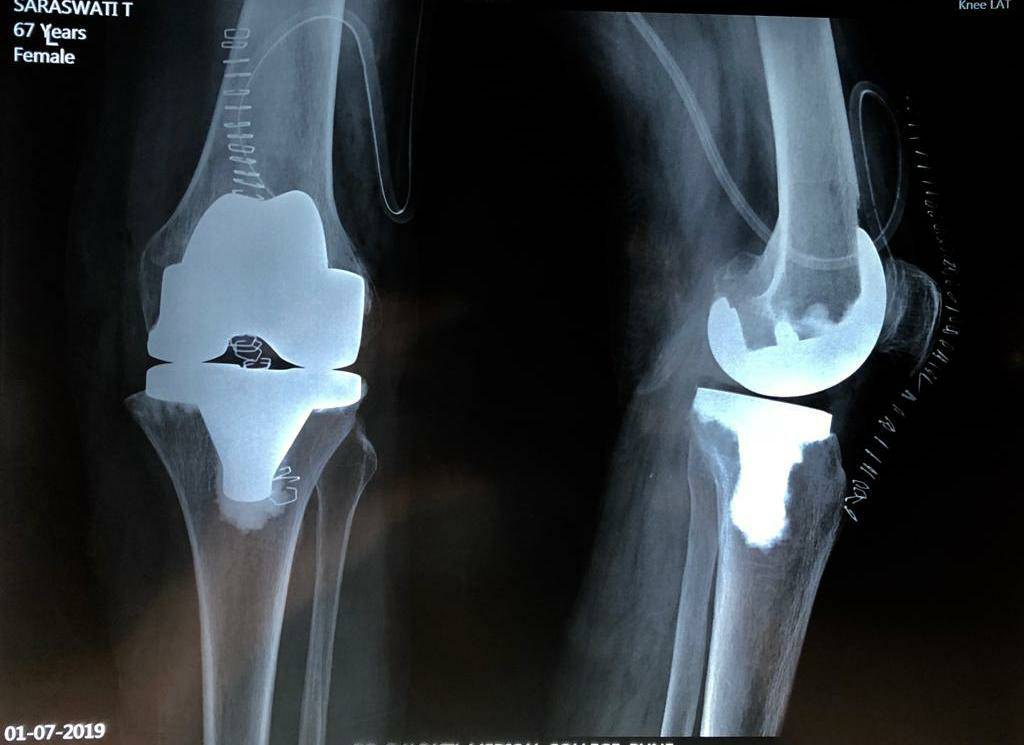 Knee replacement surgeries at affordable cost
Prim... main image