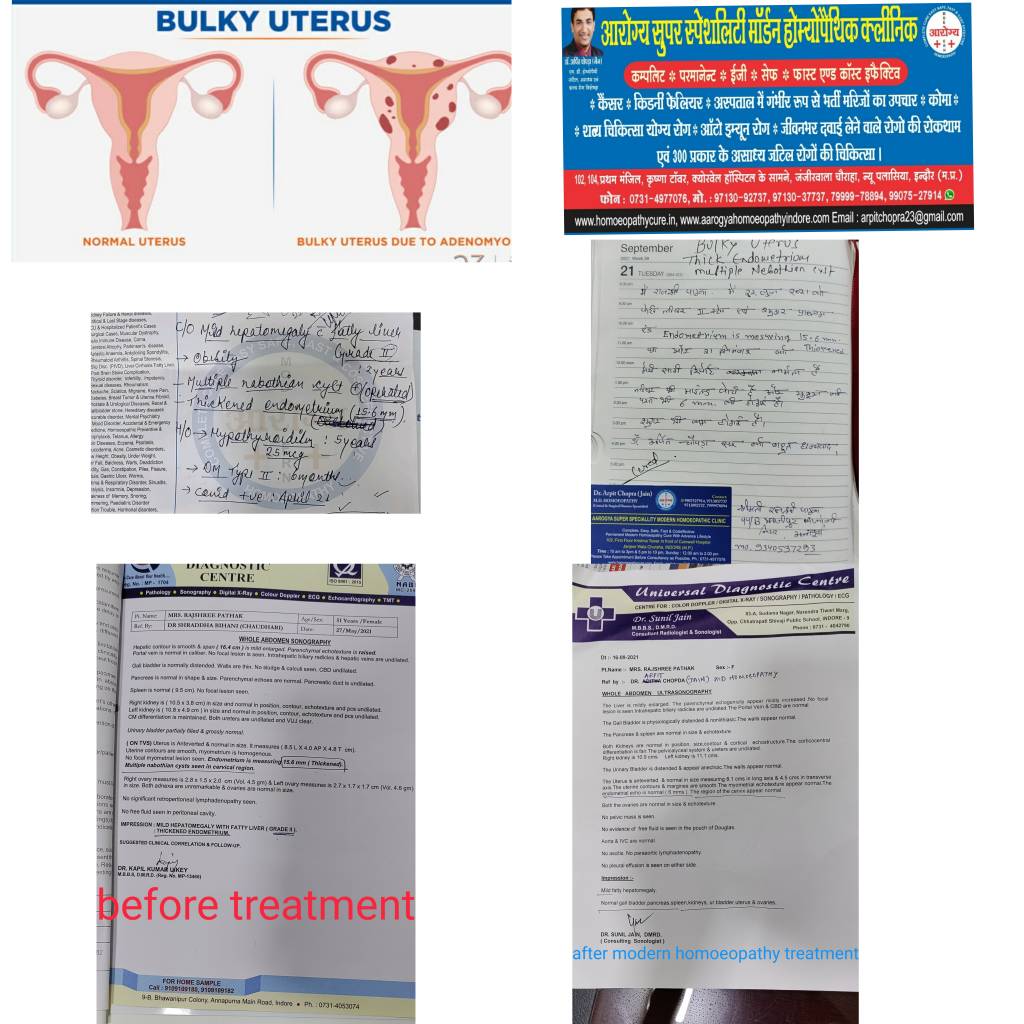 👆BULKY UTERUS 15.6 MM ENDOMETRIUM THICKNESS WITH MULTIPLE NEBOTHIAN