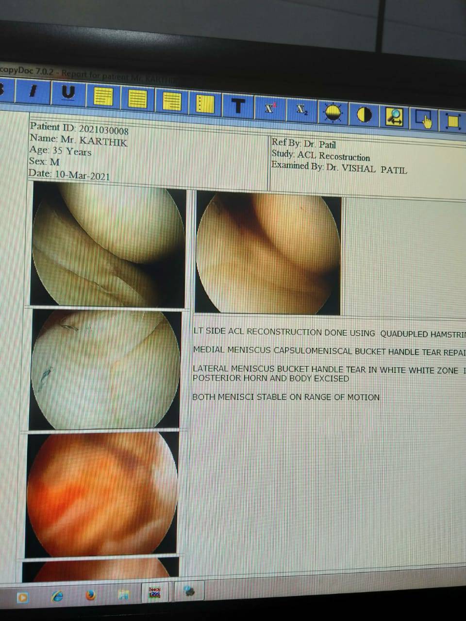 Meniscus is essential for normal functioning of... main image