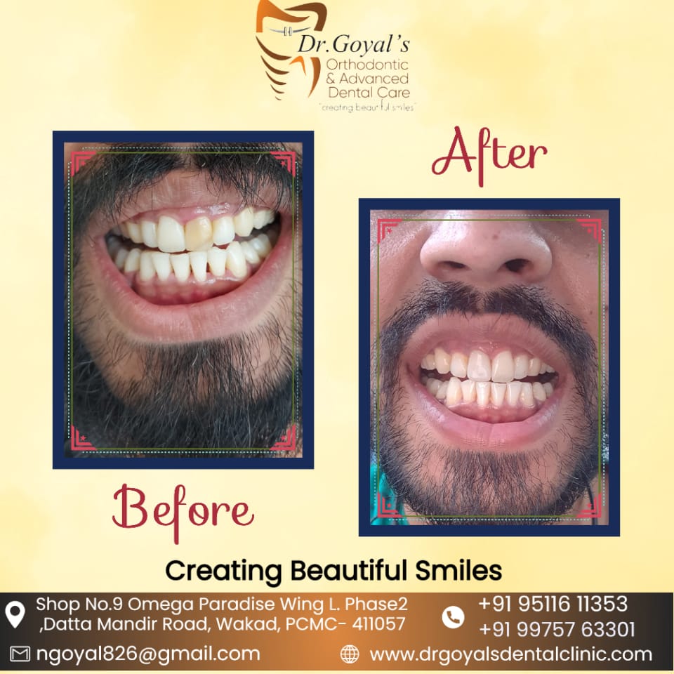 Are you finding Tooth Cleaning Clinic in Wakad ... main image